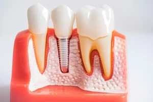 German Medigma Dental Implants